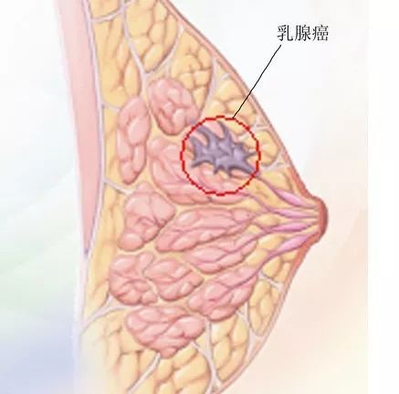 粉红120乳腺健康：每月一次乳房自测赶走乳腺癌