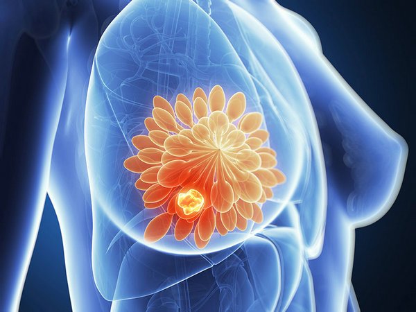 粉红120乳腺健康：乳腺癌的早期症状有哪些？