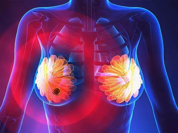 粉红120乳腺健康：乳腺纤维瘤四大明显的症状